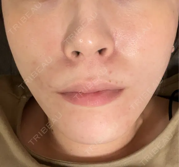 ボトックス（あご） / ボトックス（口角） MAクリニック 心斎橋 DAY 8 メイン用