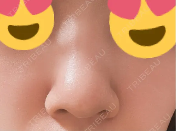 脂肪溶解注射（顔） ファイヤークリニック 銀座院 DAY 7 メイン用