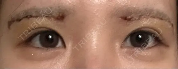 眉下切開 Barbie Clinic DAY 6 メイン用