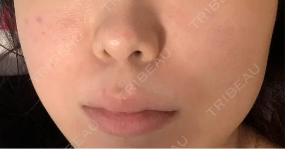 リジュラン CZEN CLINIC 銀座院 DAY 1 メイン用