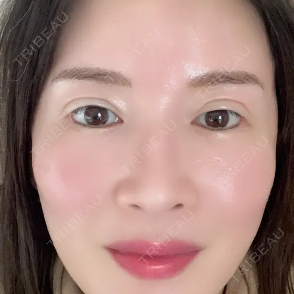 脂肪吸引（脚） / 脂肪吸引（お尻） / 脂肪注入（輪郭） Mods Clinic（モッズクリニック） 名古屋院 AFTER メイン用