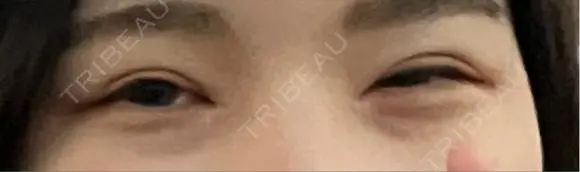 二重切開 / 目頭切開 / 上まぶたたるみ取り 湘南美容クリニック 大阪堺東院 AFTER メイン用