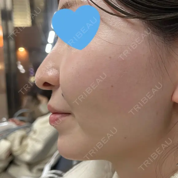 ボトックス（あご） / ヒアルロン酸注入（あご） ルラ美容クリニック 名古屋本院 DAY 0 メイン用