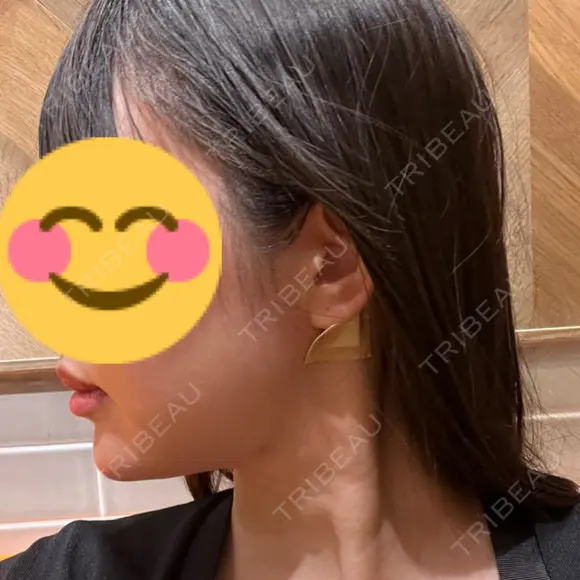 脂肪吸引（顔） ネビュラクリニック 京都院 AFTER メイン用