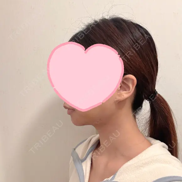 糸リフト / 脂肪吸引（顔） EMMA CLINIC（エマクリニック） DAY 7 メイン用