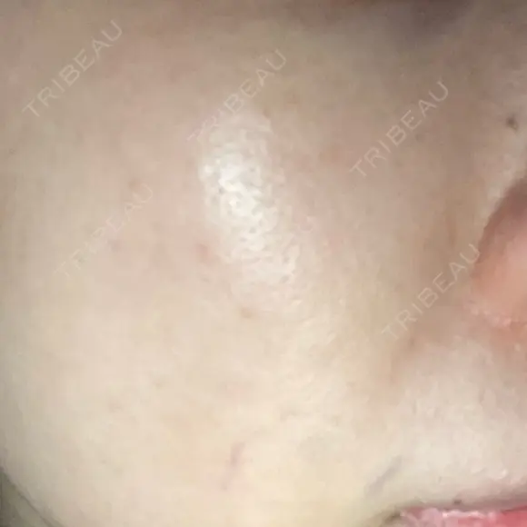 ミラノリピール ミニマムスキンクリニック池袋 AFTER メイン用