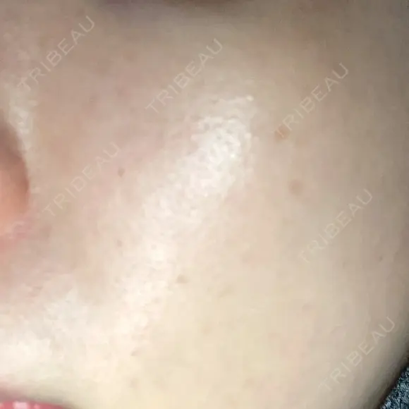 ミラノリピール ミニマムスキンクリニック池袋 DAY 7 メイン用