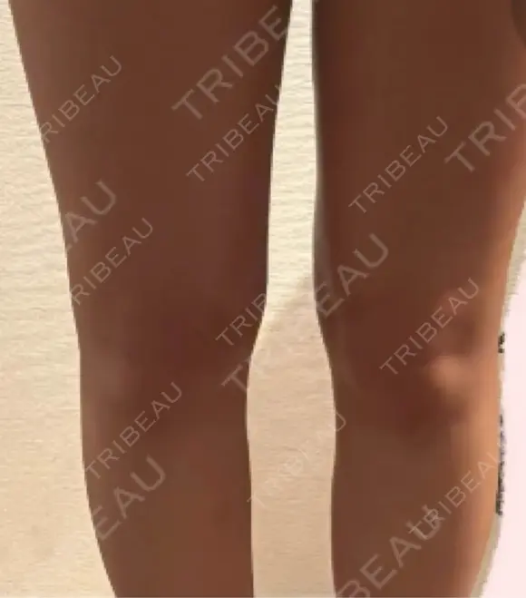 医療痩身（太もも） / 脂肪冷却（太もも） DSクリニック 新宿院 DAY 31 メイン用