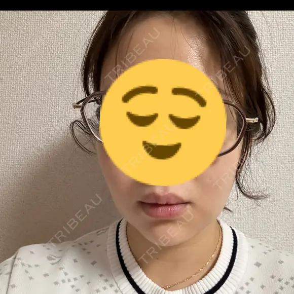 脂肪吸引（顔） / 脂肪吸引（お腹） / 脂肪吸引（腰） / ボトックス（エラ・小顔） Mods Clinic（モッズクリニック） 東京院 DAY 19 メイン用