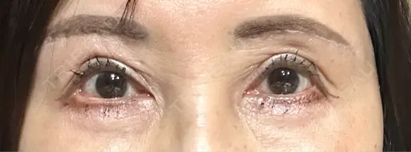 二重切開 / 眼瞼下垂（切開） / 上まぶたたるみ取り / 眉下切開 / 脂肪吸引注射（顔） / 肌ヒアルロン酸注入（たるみ・シワ改善） 東京シンデレラ美容外科 新宿院 DAY 21 メイン用