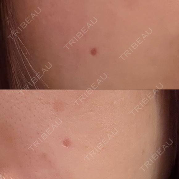 ほくろ・いぼ切除（肌） Belle Via Skin Clinic AFTER メイン用