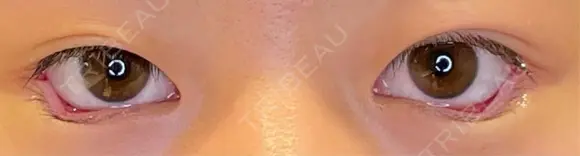 目尻切開 / タレ目形成・グラマラスライン（埋没） LOUIS CLINIC 二子玉川院【ルイクリニック】 DAY 0 メイン用