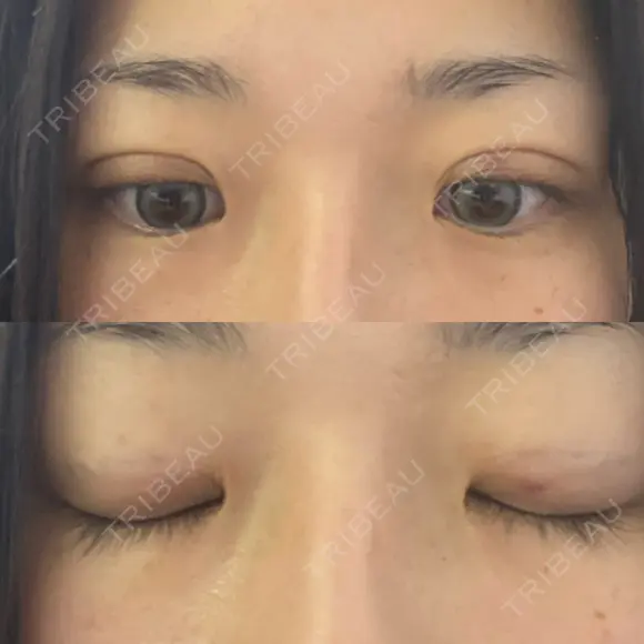 自然癒着法 銀座リシェスクリニック AFTER メイン用