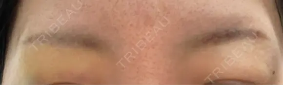 アートメイク除去・修正 渋谷美容外科クリニック 新宿院 DAY 5 メイン用