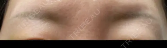 アートメイク除去・修正 渋谷美容外科クリニック 新宿院 DAY 7 メイン用