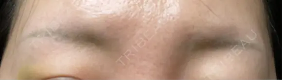 アートメイク除去・修正 渋谷美容外科クリニック 新宿院 DAY 8 メイン用