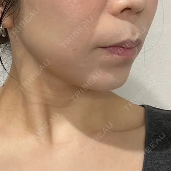ハイフ（顔） 新宿中央クリニック DAY 25 メイン用