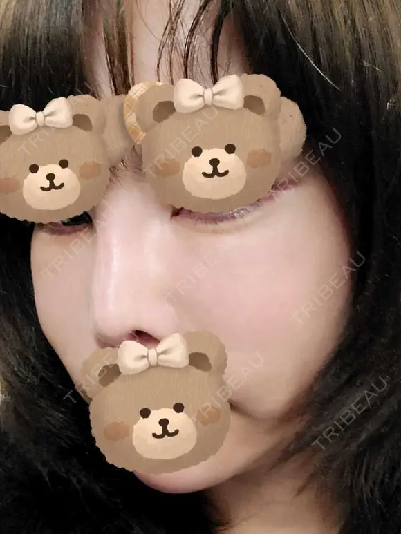 人中短縮 / ヒアルロン酸注入（涙袋） / ヒアルロン酸注入（鼻） / ヒアルロン酸注入（あご） / ヒアルロン酸注入（唇） / ヒアルロン酸注入（頬） / その他（輪郭） 共立美容外科 神戸三宮院 DAY 2 メイン用