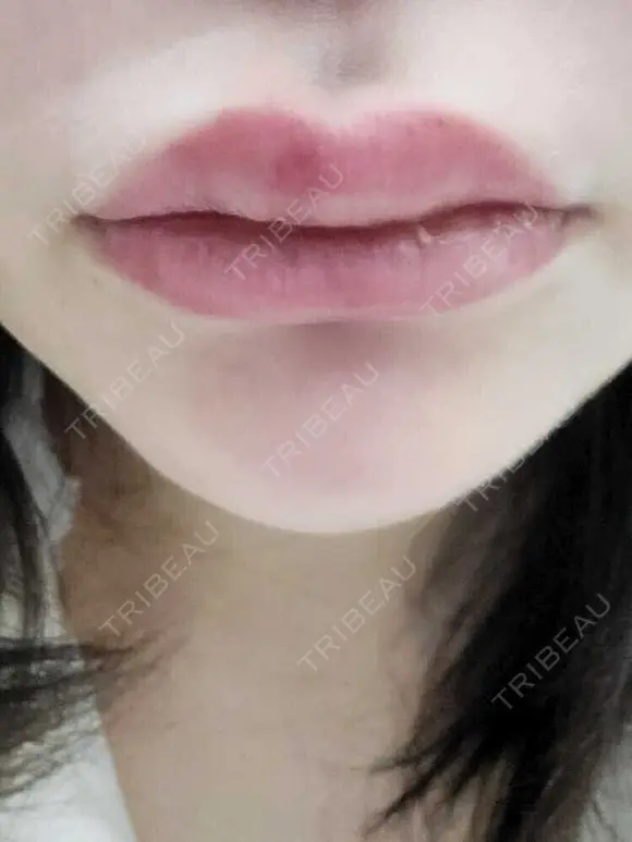 人中短縮 / ヒアルロン酸注入（涙袋） / ヒアルロン酸注入（鼻） / ヒアルロン酸注入（あご） / ヒアルロン酸注入（唇） / ヒアルロン酸注入（頬） / その他（輪郭） 共立美容外科 神戸三宮院 DAY 2 メイン用