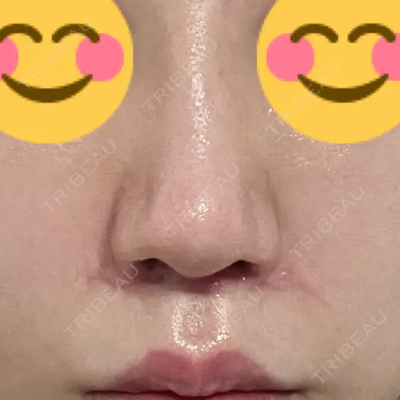 鼻尖形成（切開） / 人中短縮 / 鼻孔縁挙上 / その他（鼻） アリエル美容クリニック 大宮院 DAY 61 メイン用