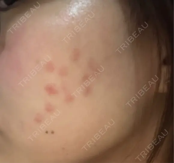 その他（肌） / 美肌レーザー こまちクリニック DAY 7 メイン用