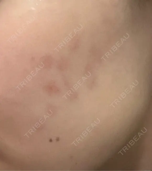 その他（肌） / 美肌レーザー こまちクリニック DAY 14 メイン用