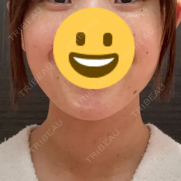 アートメイク（ほくろ） 美容皮膚科エルムクリニック 福岡院 AFTER メイン用