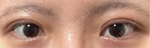 二重切開 EMMA CLINIC（エマクリニック） DAY 14 メイン用