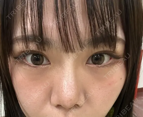 二重埋没 / 隆鼻術 / 鼻尖形成（切開） / 小鼻縮小（切開） / 軟骨移植 R Beauty CLINIC 名古屋院 DAY 51 メイン用