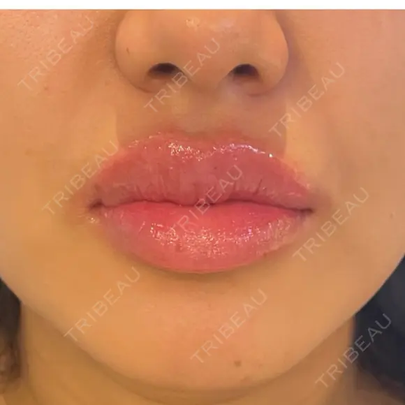 ヒアルロン酸注入（唇） 麻布十番クレールデンタルクリニック AFTER メイン用