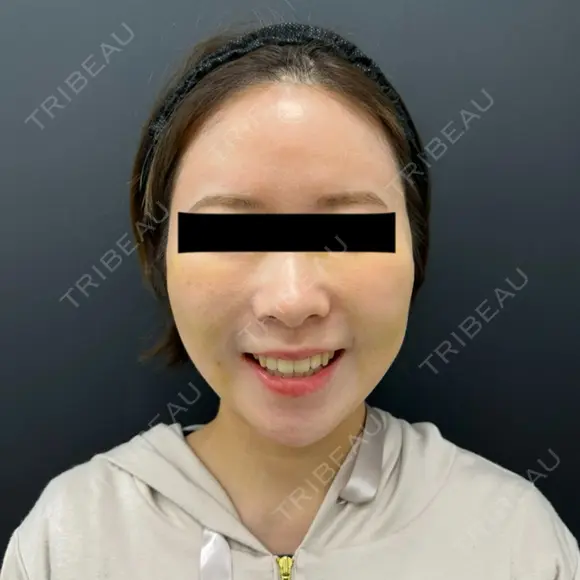 糸リフト / 脂肪吸引（顔） / メーラーファット除去 BLINC CLINIC （ブリンク クリニック） DAY 6 メイン用