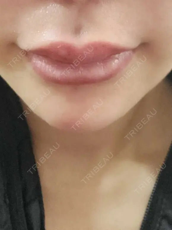 人中短縮 / ヒアルロン酸注入（涙袋） / ヒアルロン酸注入（鼻） / ヒアルロン酸注入（あご） / ヒアルロン酸注入（唇） / ヒアルロン酸注入（頬） / その他（輪郭） 共立美容外科 神戸三宮院 AFTER メイン用