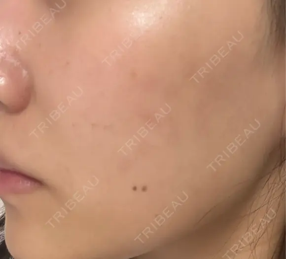 その他（肌） / 美肌レーザー こまちクリニック DAY 18 メイン用