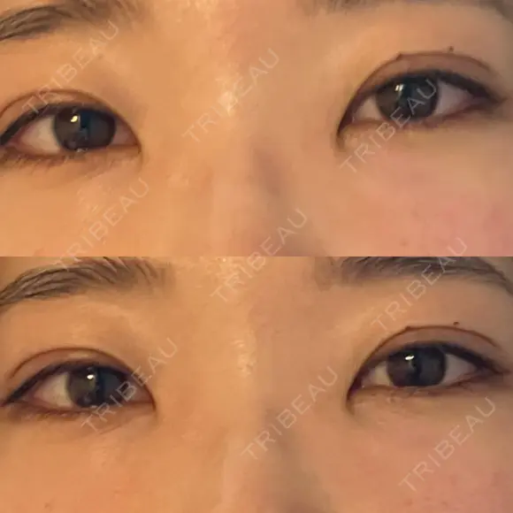 二重埋没 宇都宮竹内クリニック AFTER メイン用