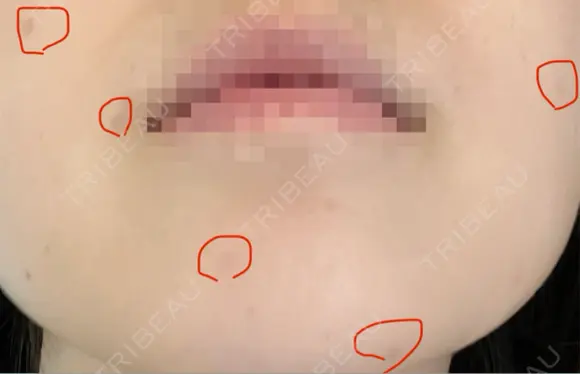 ほくろ・いぼ切除（肌） KARIS beauty clinic AFTER メイン用