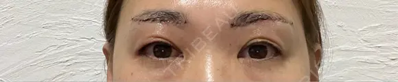眉下切開 / ボトックス（眉間） / ボトックス（目尻） PRO CLINIC プロクリニック 銀座院 DAY 1 メイン用