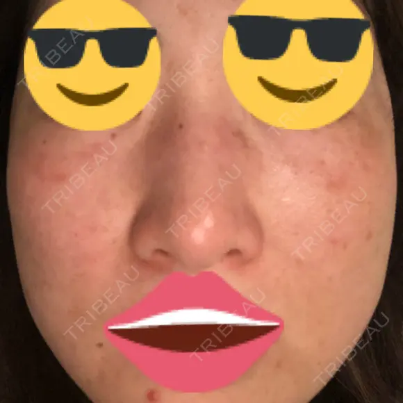 プラセンタ注射 / シミ取りレーザー 仁愛クリニック DAY 19 メイン用