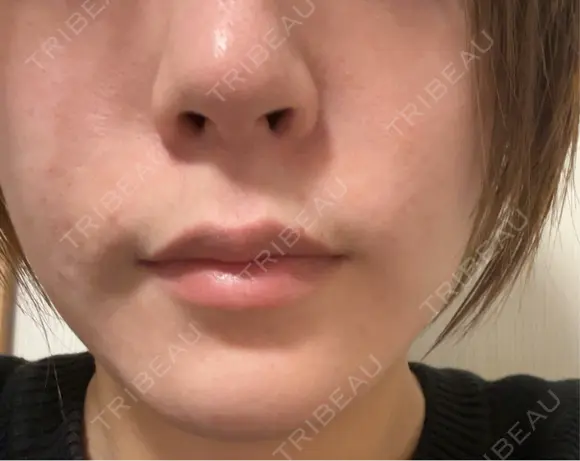 ボトックス（あご） / ボトックス（口角） MAクリニック 心斎橋 AFTER メイン用