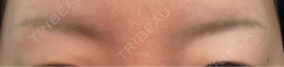 アートメイク除去・修正 渋谷美容外科クリニック 新宿院 DAY 11 メイン用