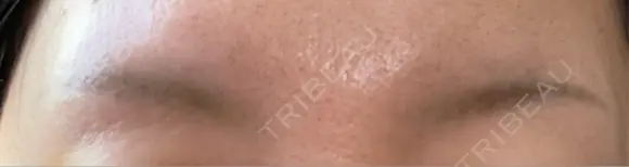 アートメイク除去・修正 渋谷美容外科クリニック 新宿院 DAY 10 メイン用