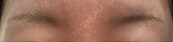 アートメイク除去・修正 渋谷美容外科クリニック 新宿院 DAY 12 メイン用