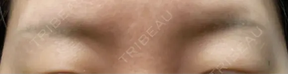 アートメイク除去・修正 渋谷美容外科クリニック 新宿院 DAY 12 メイン用