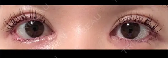 目尻切開 / タレ目形成・グラマラスライン（埋没） LOUIS CLINIC 二子玉川院【ルイクリニック】 DAY 2 メイン用