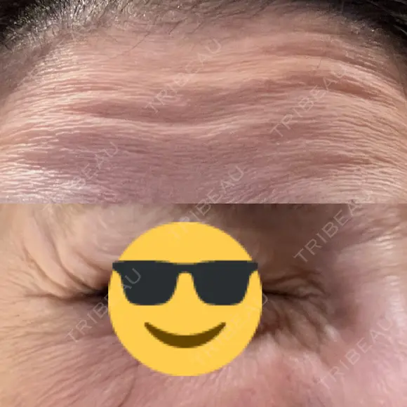 ボトックス（あご） / ボトックス（口角） / ボトックス（眉間） / ボトックス（目尻） / ボトックス（額） DMTC CLINIC 日本橋院 DAY 0 メイン用