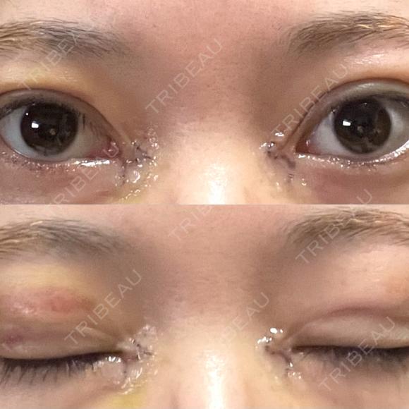 二重埋没 / 目頭切開 アリエル美容クリニック 郡山院 DAY 6 メイン用
