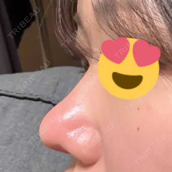 鼻尖形成（切開） / 軟骨移植 / 鼻尖縮小 / 鼻翼基部形成（貴族手術） / ヒアルロン酸注入（鼻翼基部） 東京シンデレラ美容外科 新宿院 DAY 38 メイン用