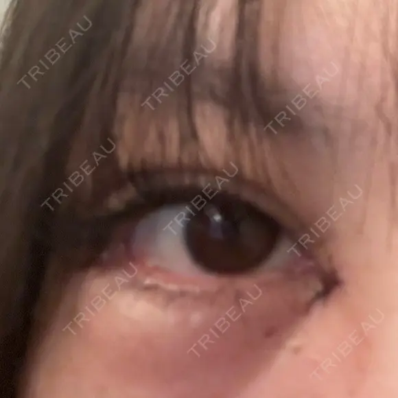 目頭切開 / 糸リフト / 脂肪吸引（顔） / 目尻切開 / タレ目形成・グラマラスライン（切開） / ジョールファット除去 / ヒアルロン酸注入（あご） / ヒアルロン酸注入（額） Tokyo Tensei Clinic 新宿院 AFTER メイン用