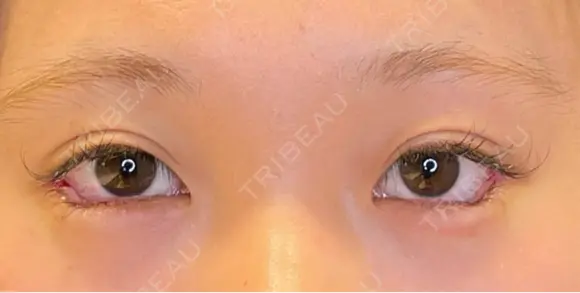 目尻切開 / タレ目形成・グラマラスライン（埋没） LOUIS CLINIC 二子玉川院【ルイクリニック】 DAY 0 メイン用