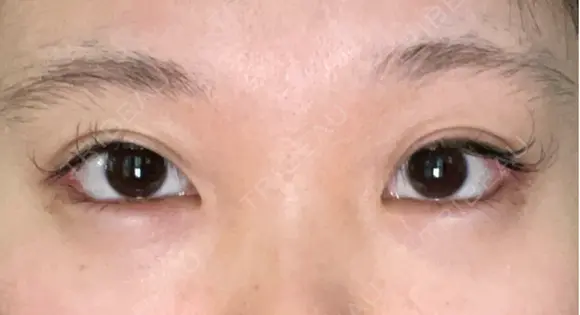 目尻切開 / タレ目形成・グラマラスライン（埋没） LOUIS CLINIC 二子玉川院【ルイクリニック】 DAY 0 メイン用