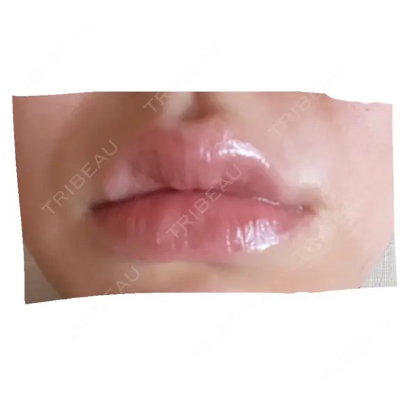 ヒアルロン酸注入（唇） シンデレラ＆ダヴィンチクリニック AFTER メイン用